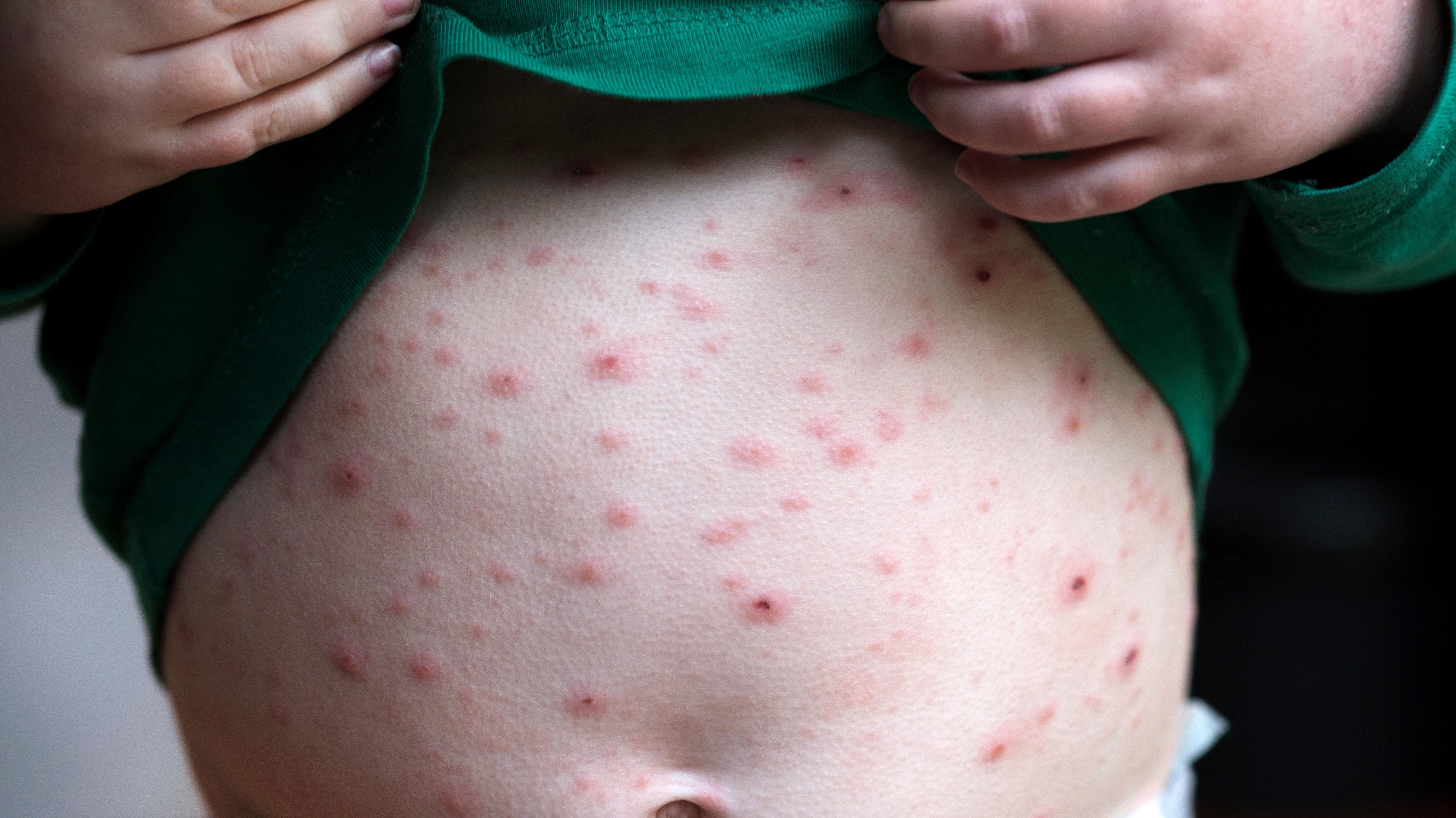 Chickenpox vaccine should be given to all children on the NHS