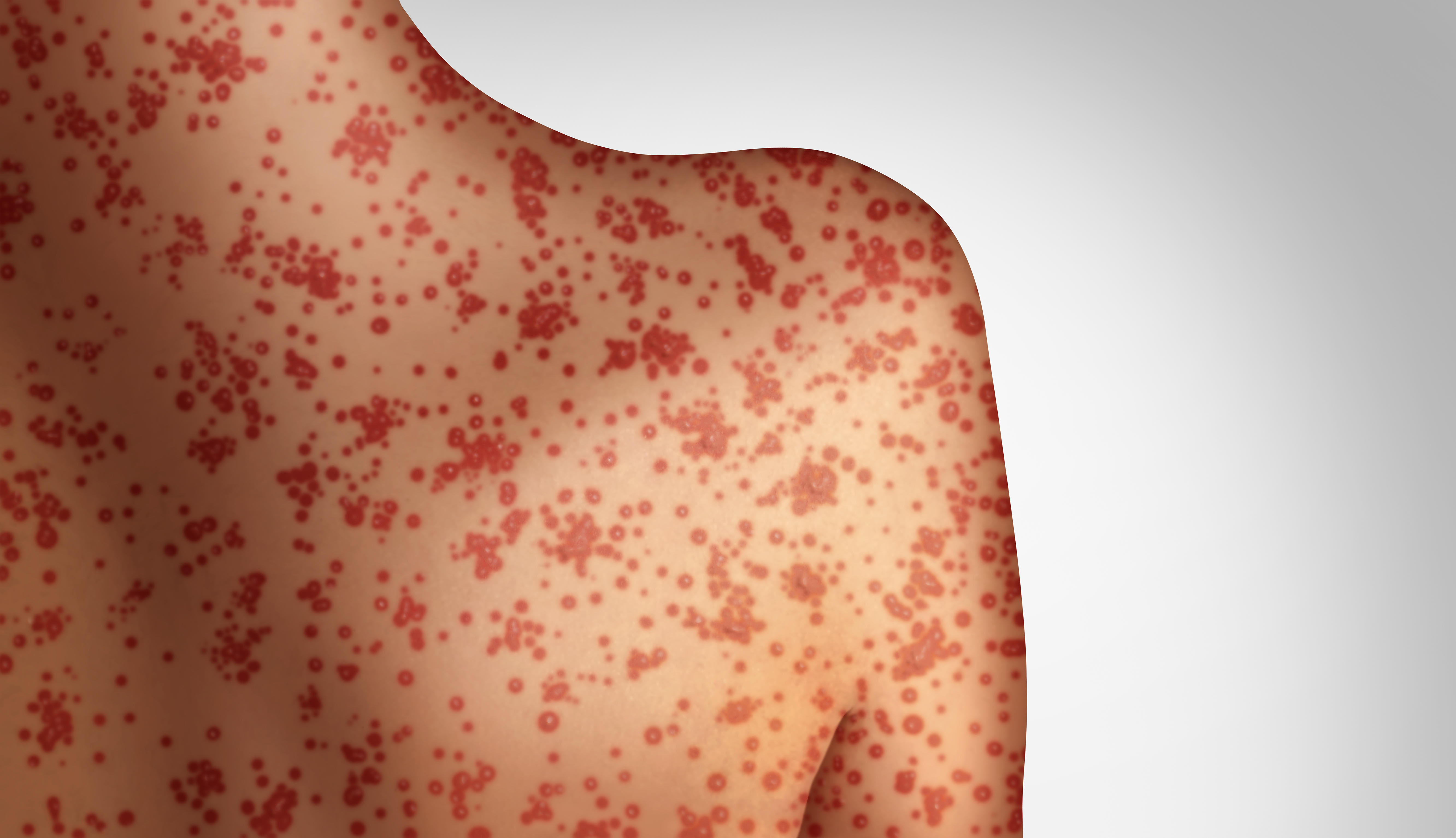 Measles more infectious than Covid, says Professor